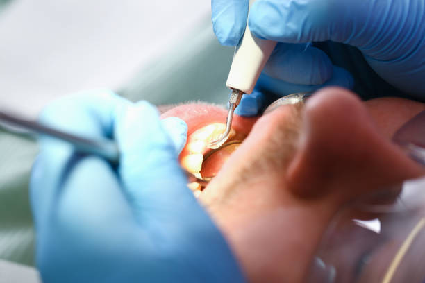 Best Emergency Root Canal Treatment in Snow Hill, MD